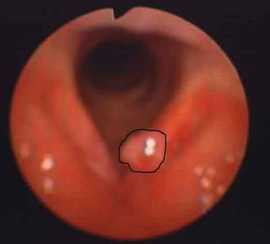 聲帶息肉的癥狀