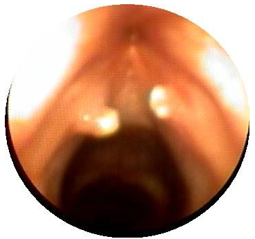 聲帶小結在儀器下的表現癥狀