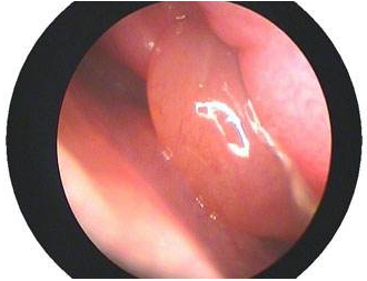(慢性鼻炎的危害鼻息肉)