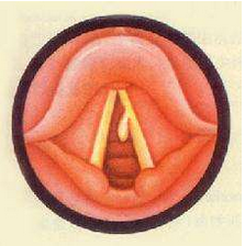 聲帶息肉的結構圖