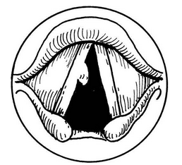 聲帶息肉的結(jié)構(gòu)圖