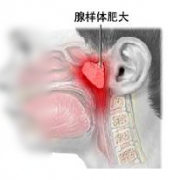 腺樣體肥大癥狀圖