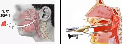 手術治療腺樣體肥大