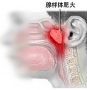 腺樣體肥大的癥狀圖