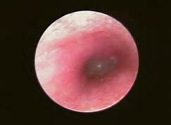 外耳道炎的內窺鏡檢查圖