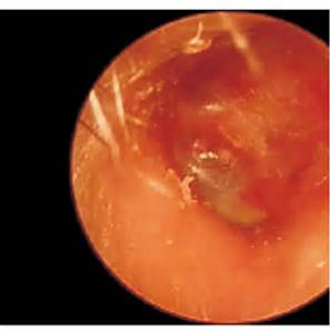 術(shù)后外耳道乳突腔內(nèi)鏡圖