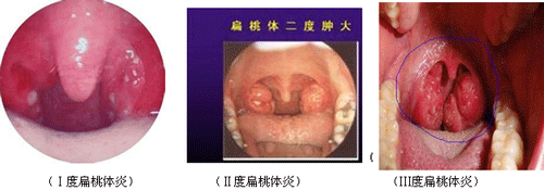 三種扁桃體肥大的程度