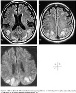 眩暈癥的CT檢查圖