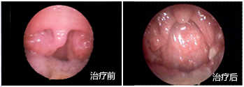 扁桃體肥大治療前后