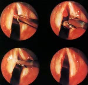 聲帶息肉的內窺鏡檢查