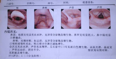 聲帶小結的檢查報告