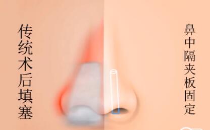 鼻中隔夾板術與傳統(tǒng)術后填塞對比