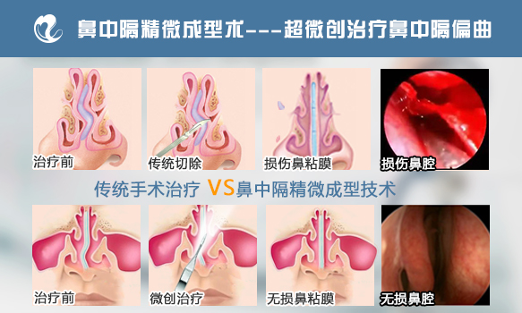 鼻中隔偏曲兩種手術方法的對比