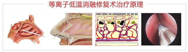 鼻甲肥大——dlzxrsxfs治療原理